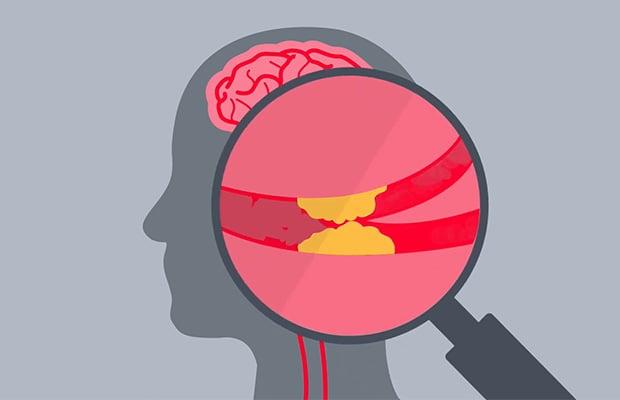 Vascular Dementia Diabetes of the Brain